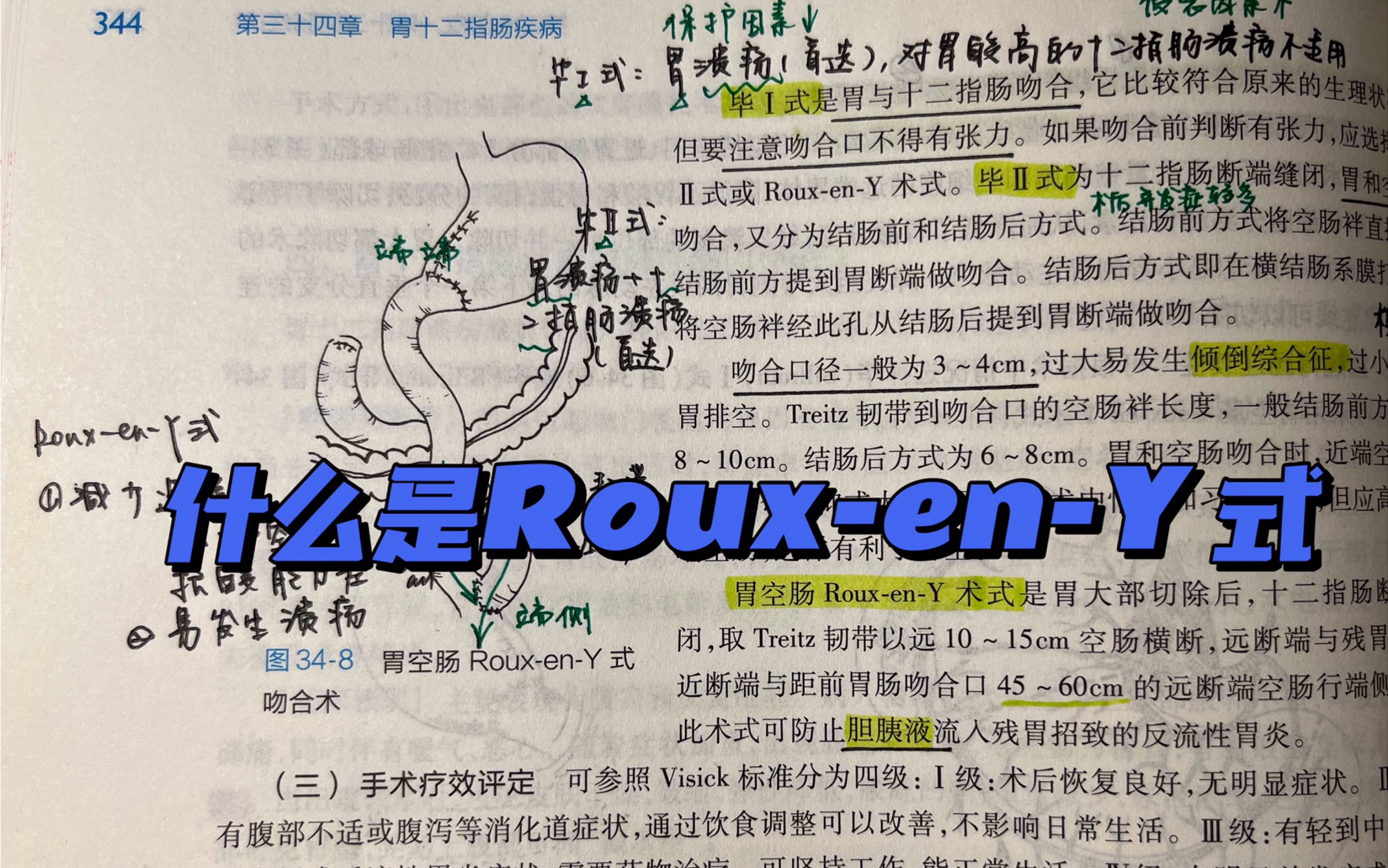 胃空肠RouxenY式吻合术哔哩哔哩bilibili