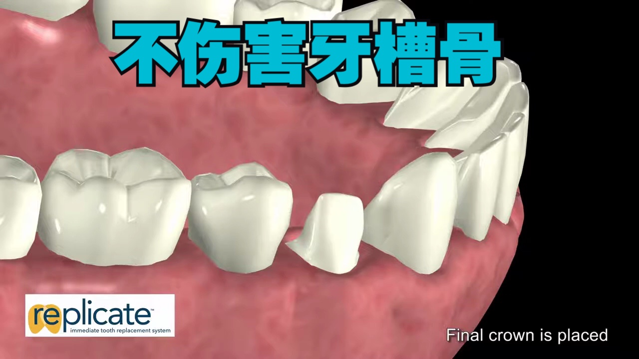 复制,及时换牙系统【免钻牙槽骨,种植牙】新一代种植牙,手术过程演示哔哩哔哩bilibili