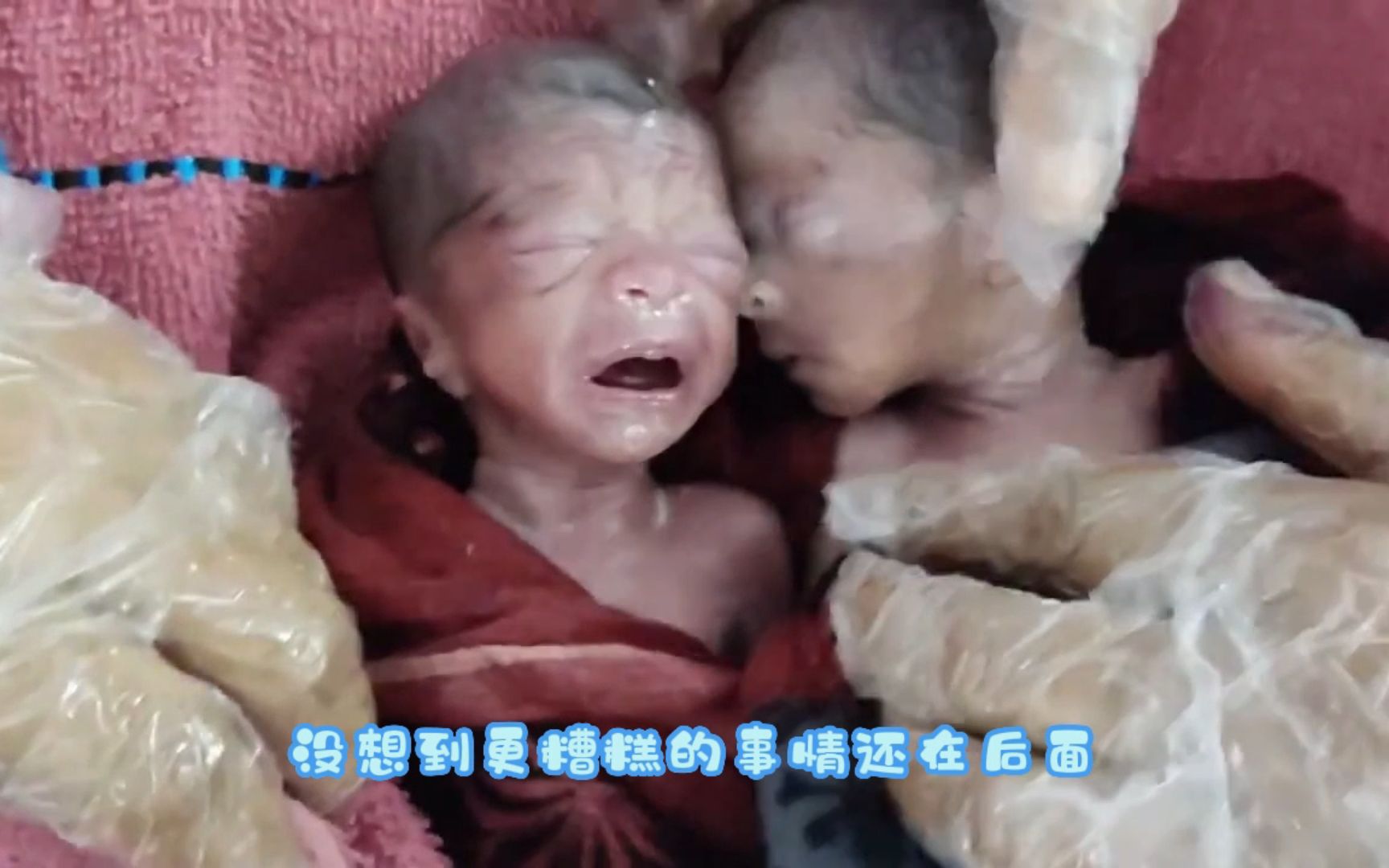 刚出生的双胞胎婴儿,医生看了直发愁,背后原因让人心酸