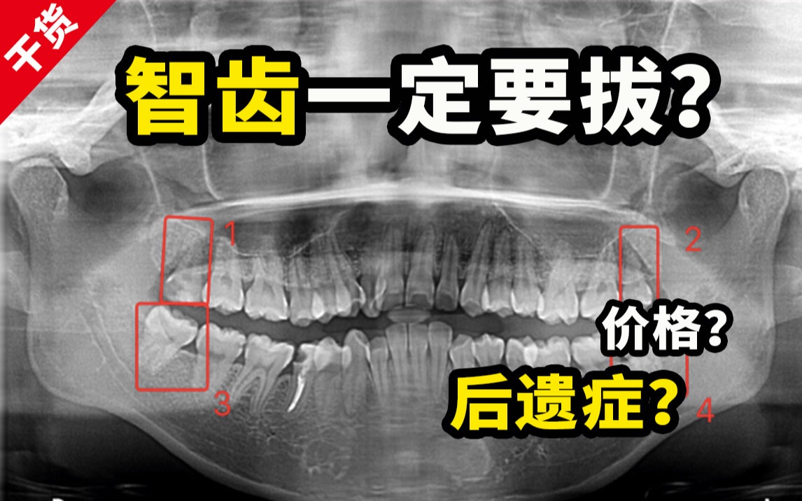 【拔牙攻略】哪些智齿一定要拔?拔完4颗我升仙了...拔牙的一切问题都在这了哔哩哔哩bilibili