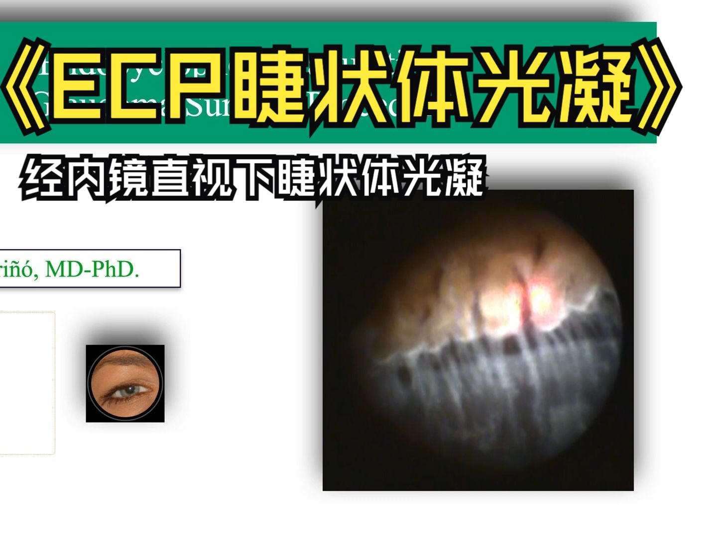 【ECP:经内镜直视下睫状体光凝】Endocyclophotocoagulation Glaucoma Surgical Procedure哔哩哔哩bilibili