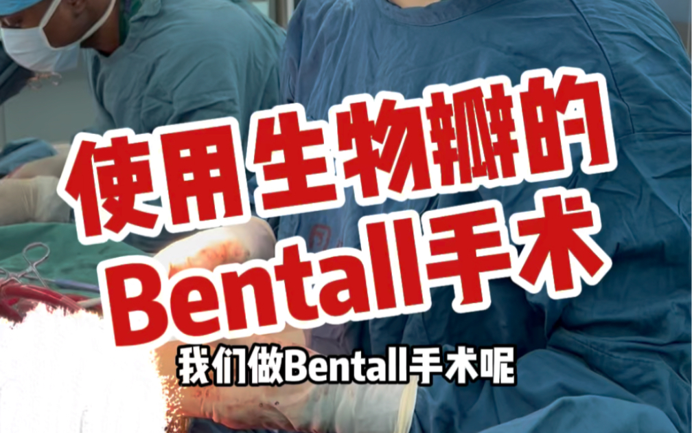 Bentall手术也可以用生物瓣.哔哩哔哩bilibili