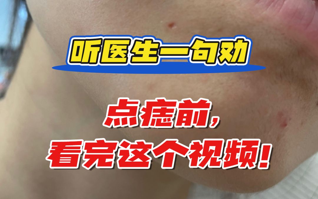 听医生一句劝:点痣前,看完这个视频!哔哩哔哩bilibili