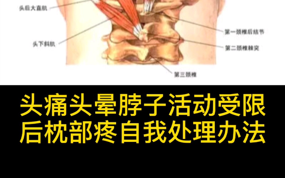 颈椎病头晕头疼脖子活动受限后枕部疼自我处理办法.哔哩哔哩bilibili