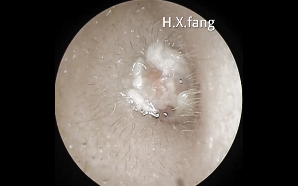 (去色版)专业可视采耳-耳垢清除,外耳道新生物 20240228.04