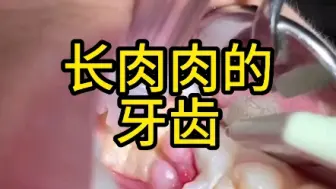 Download Video: 长肉肉的牙齿