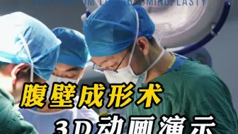 3D动画演示腹壁成形术#腹壁成形