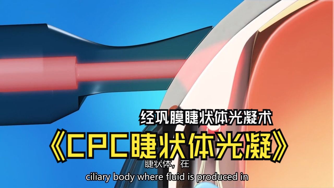 【cpc:青光眼经巩膜睫状体光凝】glaucoma cyclophotocoagulation