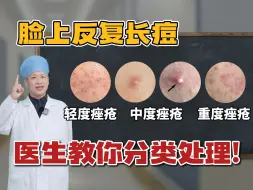 Tải video: 【科普】如果你脸上总是反复长痘痘，医生教你分类处理！