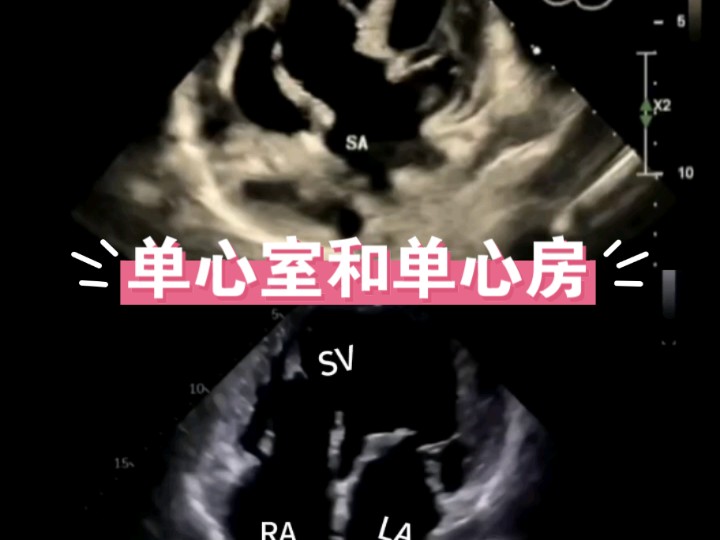 单心室和单心房,将越来越罕见哔哩哔哩bilibili