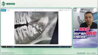 Télécharger la video: 拔除阻生齿遇到严重的并发症如何处理——杨勇