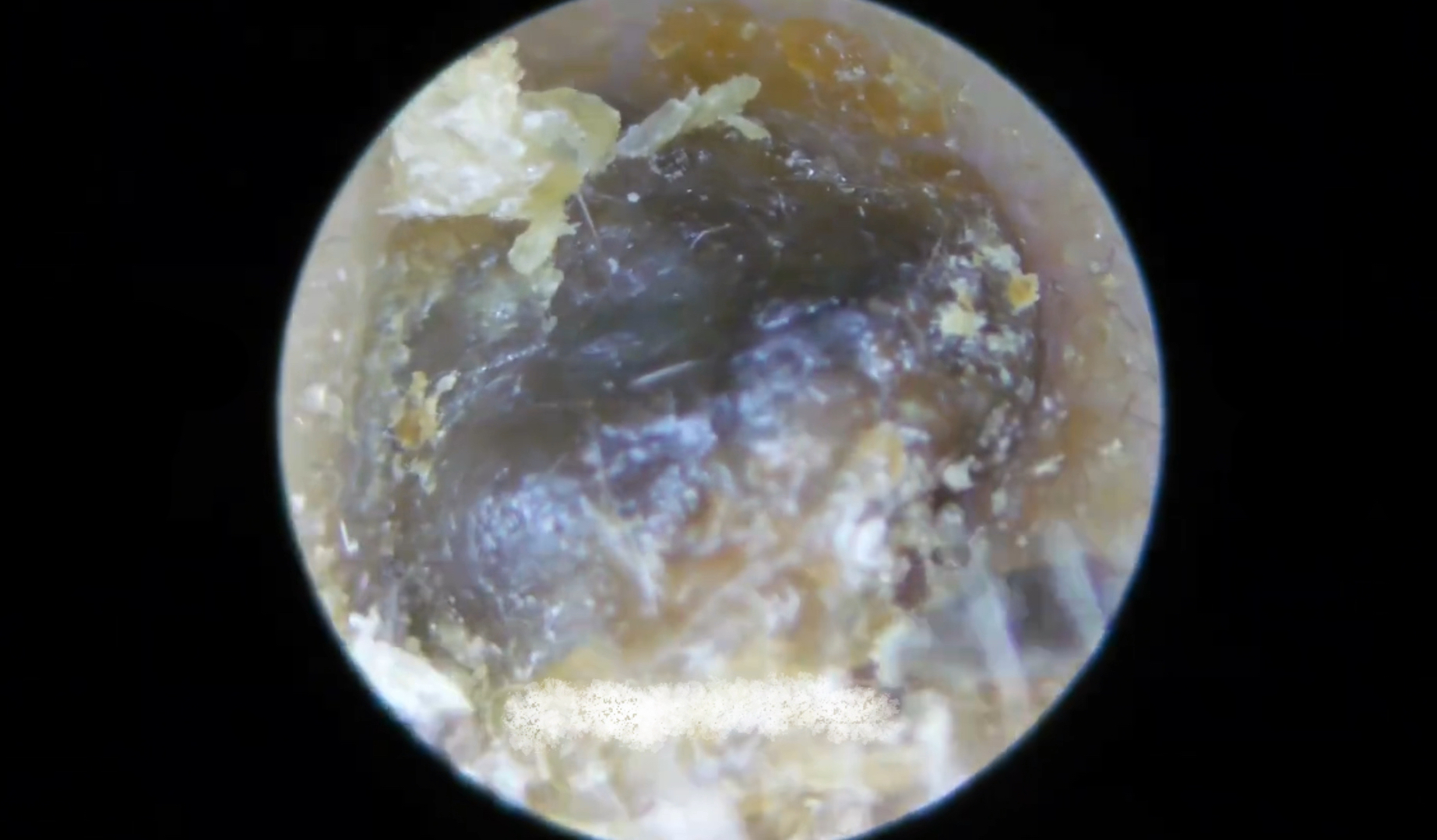 小女孩耳朵里堵了好大一坨耳屎