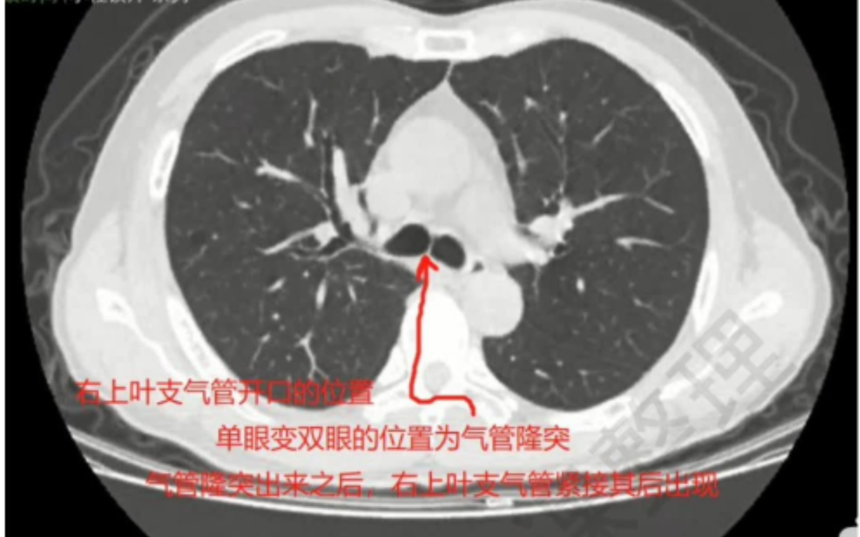 [图]肺CT的傻瓜式学习笔记，0基础的同学建议使用