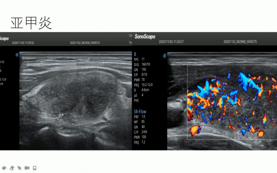 [图]甲状腺常见疾病的超声诊断及超声诊断思路