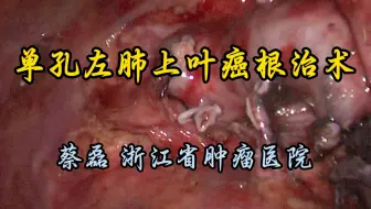 单孔胸腔镜左肺上叶癌根治术 蔡磊教授供稿