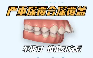 下载视频: 【矫正方案】严重深覆合深覆盖，不拔牙推磨牙矫正