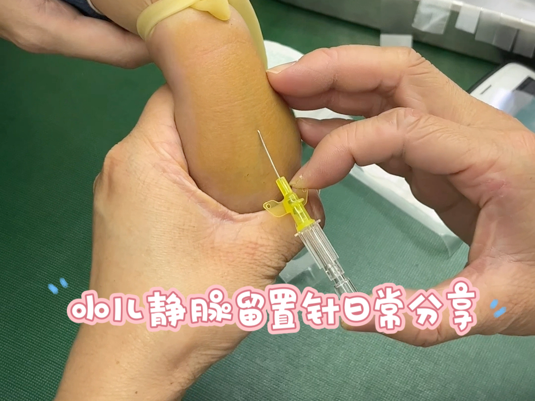 小儿静脉留置针日常分享