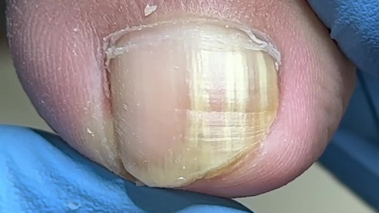 一层层剥掉灰指甲