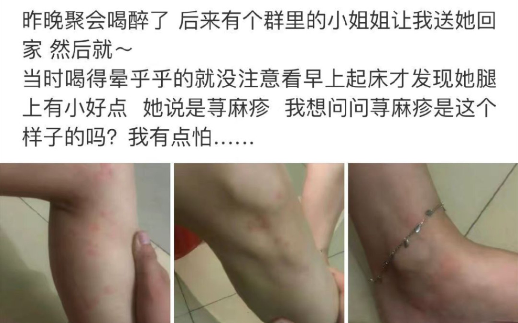 [图]荨麻疹是这个样子的吗