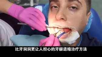 Скачать видео: 牙龈退缩的6个治疗方法