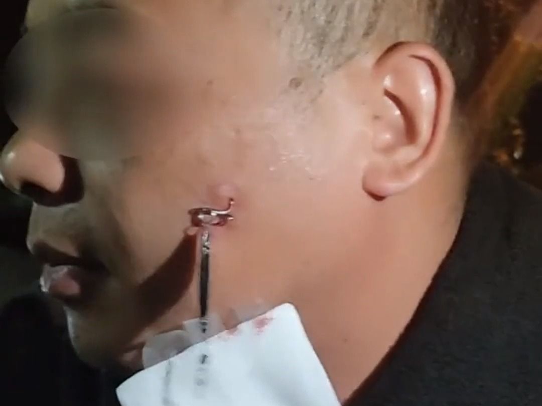 男子夜钓被路亚钩勾到脸,嵌入皮肉深处,深夜上门求助消防员