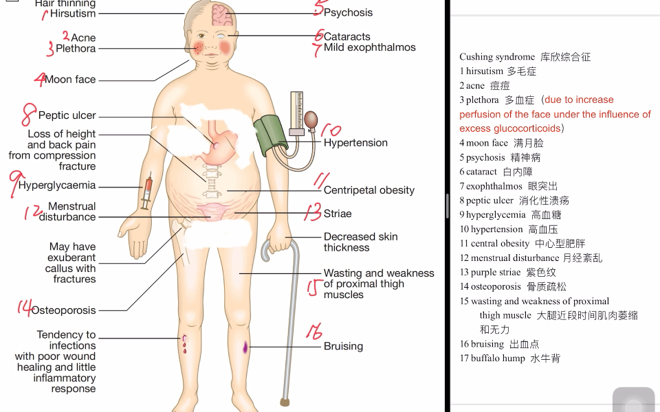 一图掌握Cushing syndrome库欣综合症体征,并发症和其英语读法哔哩哔哩bilibili