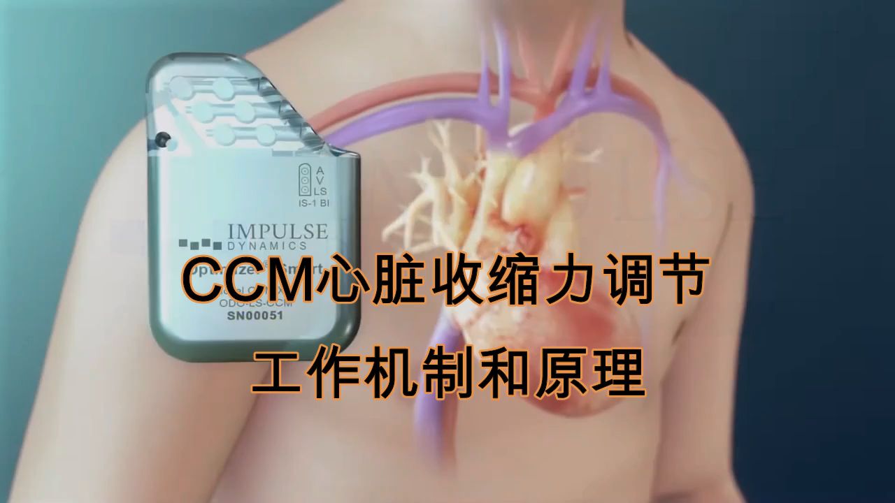 心衰新器械:CCM的原理和机制哔哩哔哩bilibili