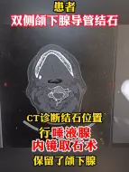 下载视频: 双侧颌下腺导管结石