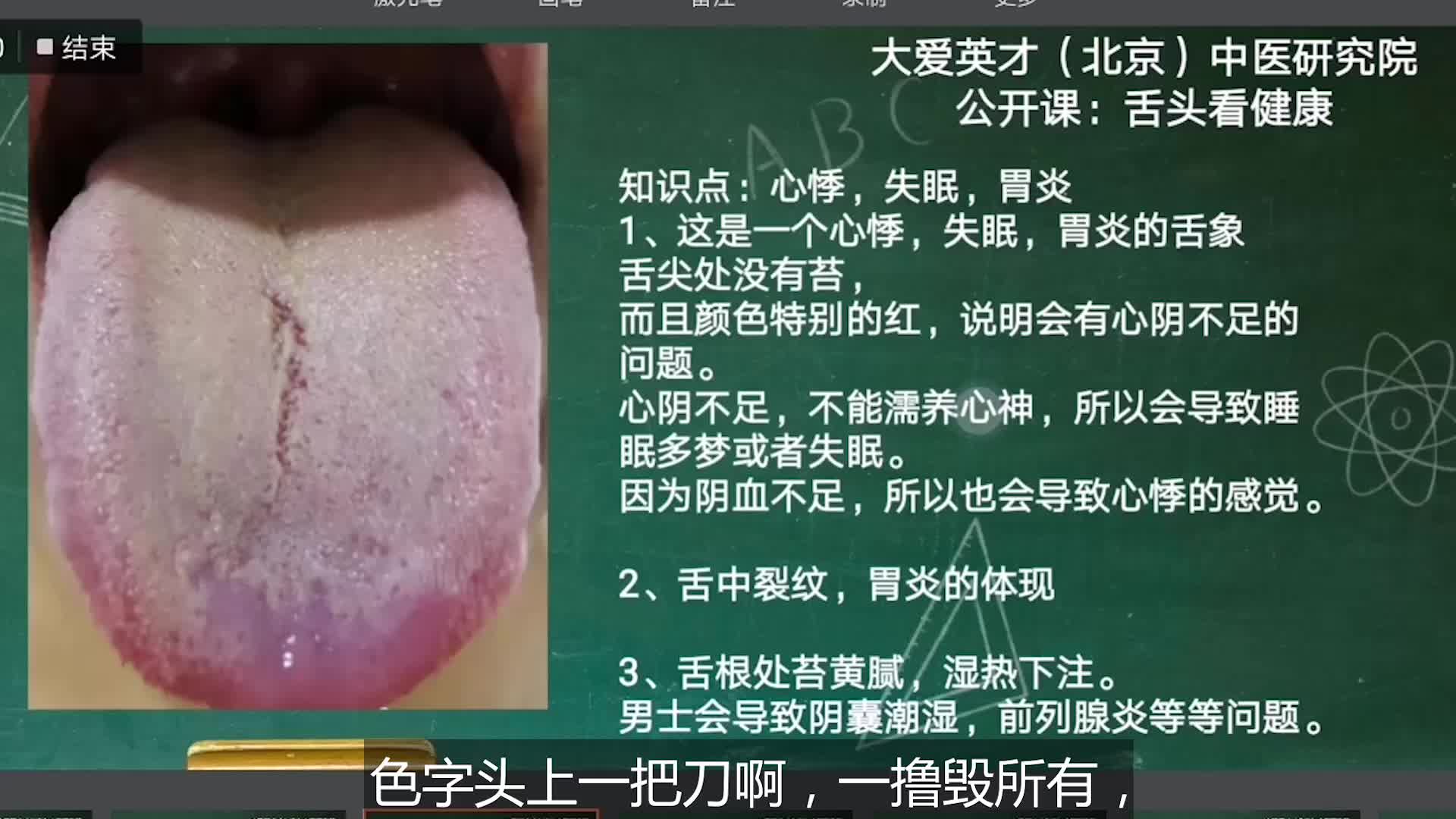 舌象分析:阴囊潮湿,前列腺炎,舌苔黄腻的舌象讲解哔哩哔哩bilibili