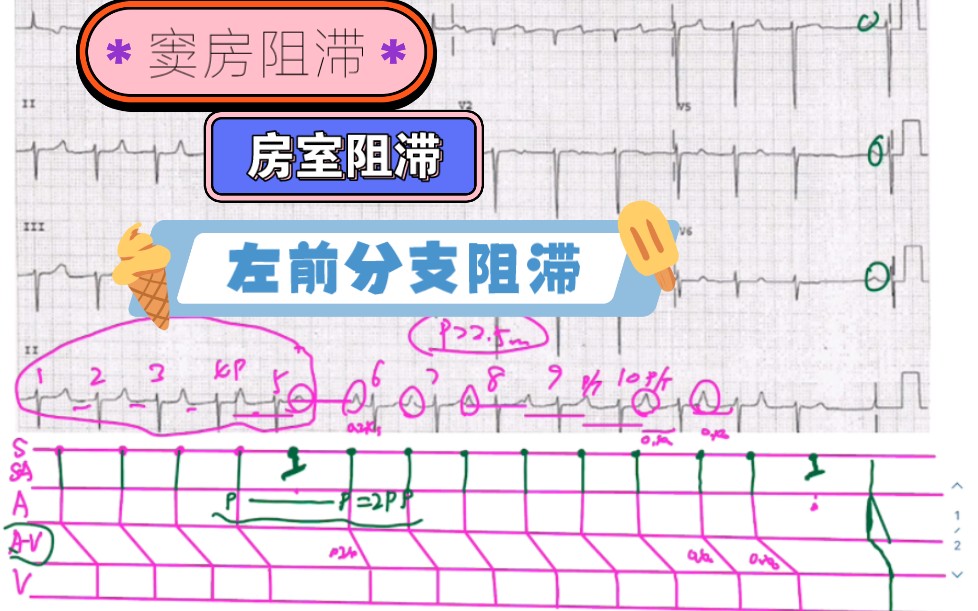 窦性心律,IIⰦˆ🥮䤼 导阻滞,窦房结传出阻滞,肺性P波,左前分支阻滞导致(V1V5的R波递增不良,顺钟向转位,stt改变).哔哩哔哩bilibili