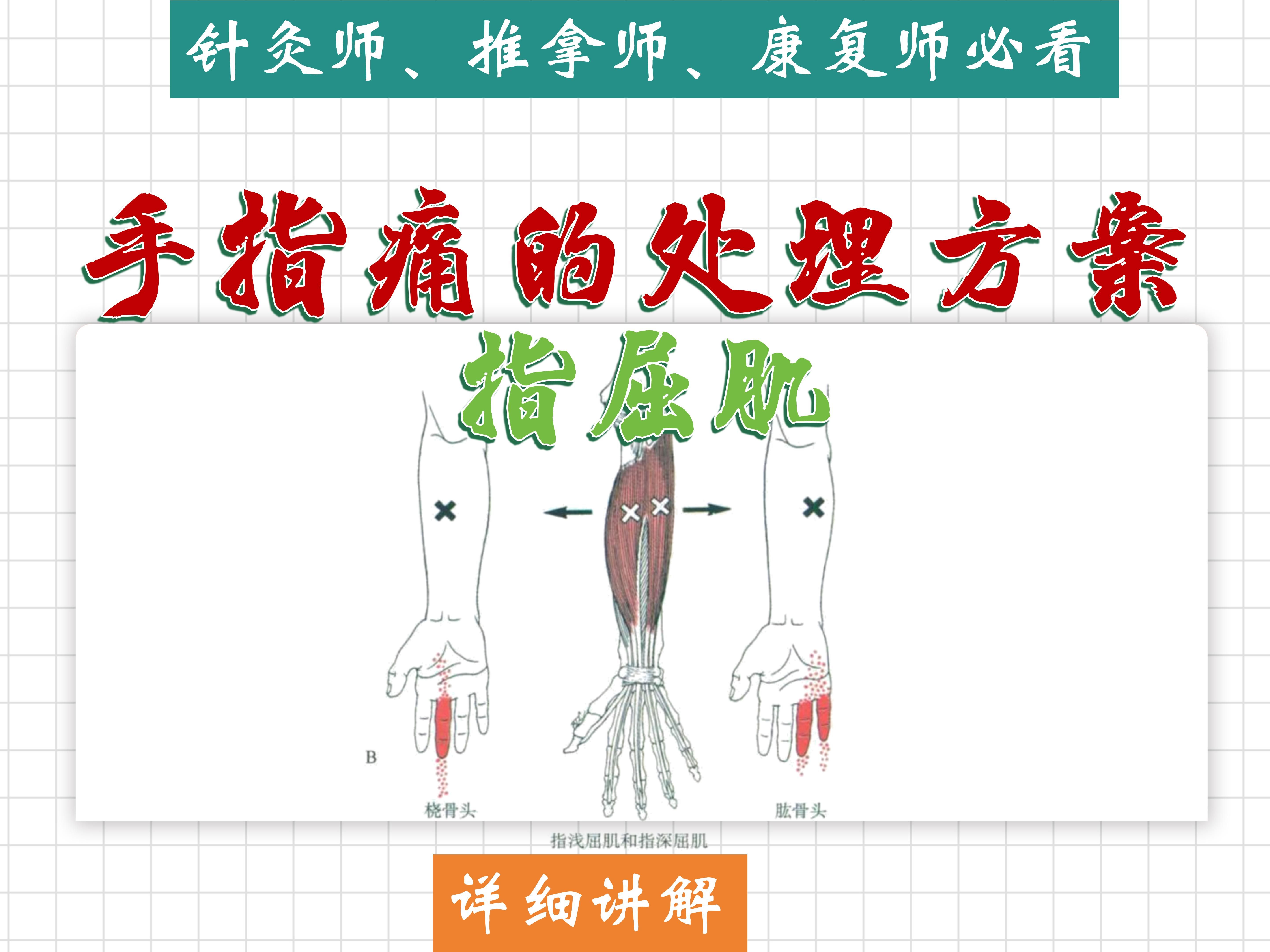 【手指痛(掌面痛)】涉及肌肉(指屈肌)详细讲解——位置、功能、激痛点、处理方法——天下明医平台简灵奇针哔哩哔哩bilibili