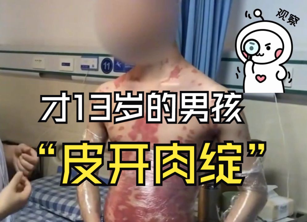 才13岁的男孩”皮开肉绽“!哔哩哔哩bilibili