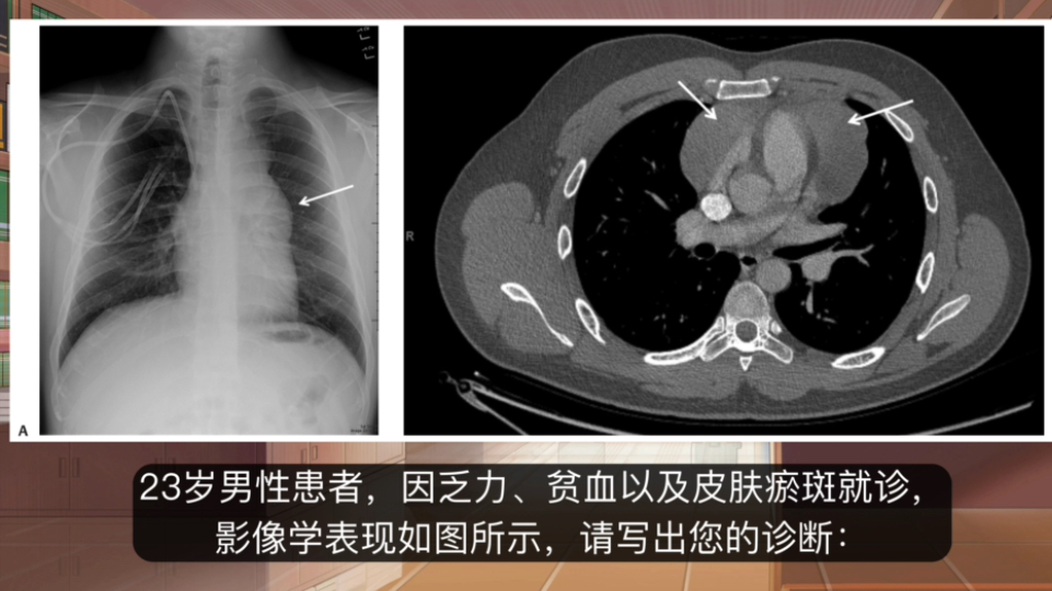 年轻患者的乏力、贫血、皮肤瘀斑伴纵隔占位,不结合临床症状真心想不到是这个病.哔哩哔哩bilibili