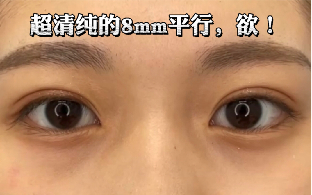 超清纯的8mm平行双眼皮,一个字:欲!