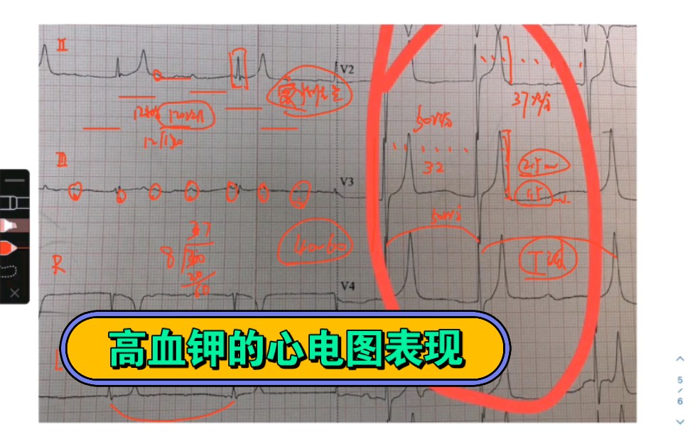 窦性心动过速,三度房室传导阻滞,交界区逸搏心律不齐,T波高尖哔哩哔哩bilibili