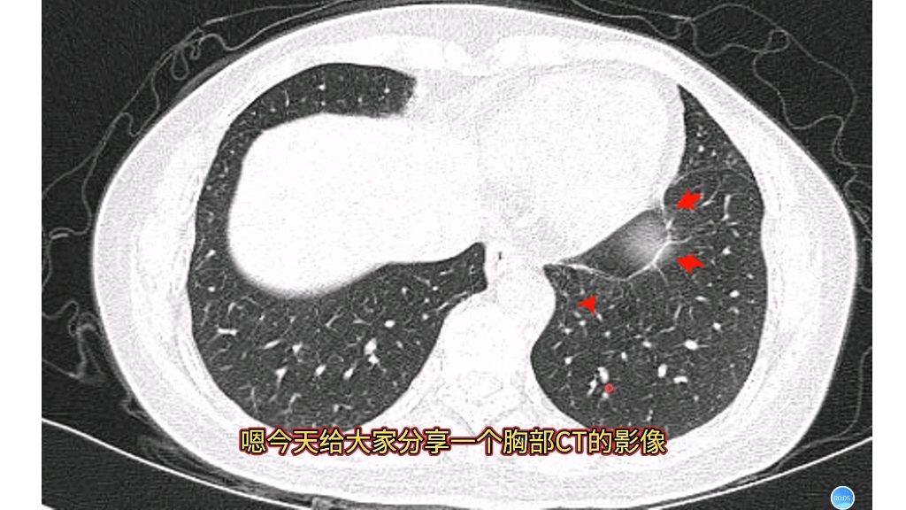肺韧带CT表现,放射科医生讲解,简单易懂!哔哩哔哩bilibili