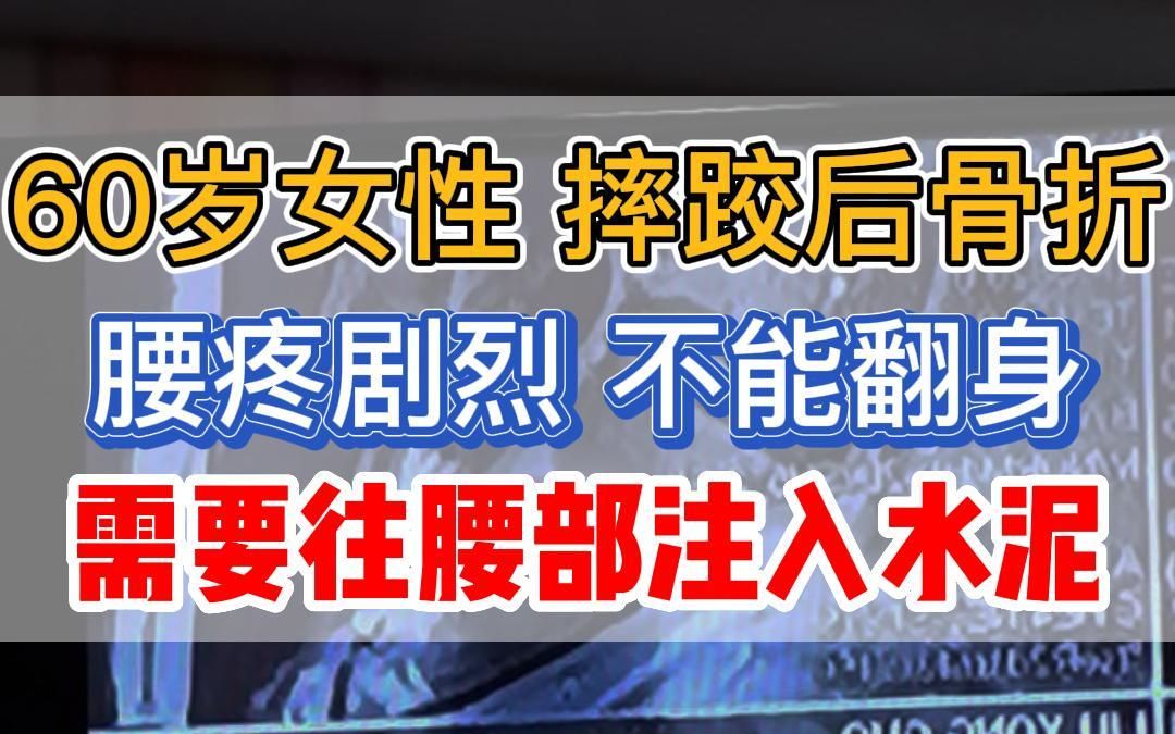 60岁女性,摔跤后骨折,需要往腰部注入水泥治疗!哔哩哔哩bilibili