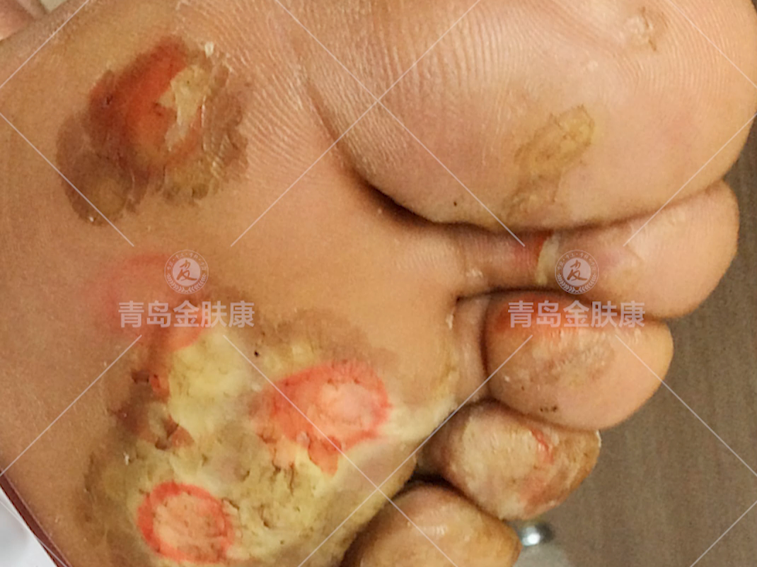 青岛金肤康皮肤病医院应对跖疣效果不错