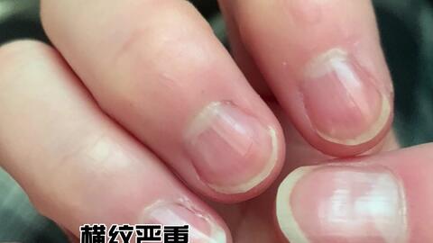 指甲不好看?游离线低,甲床小怎么办?生长啫喱帮你忙| 一个月改善