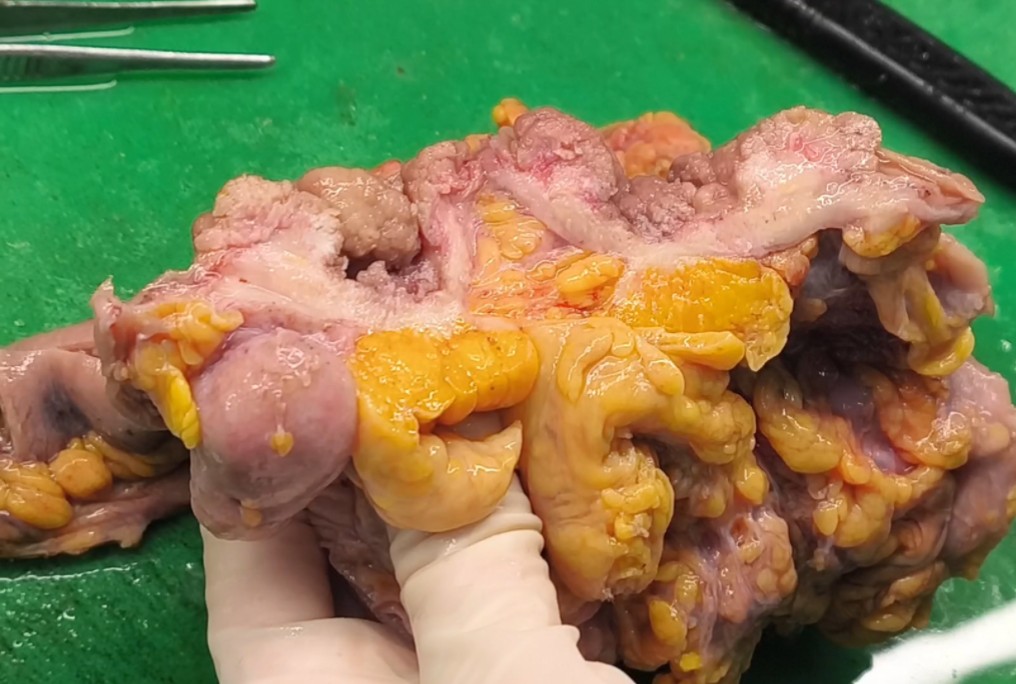 巨大结肠息肉恶变!