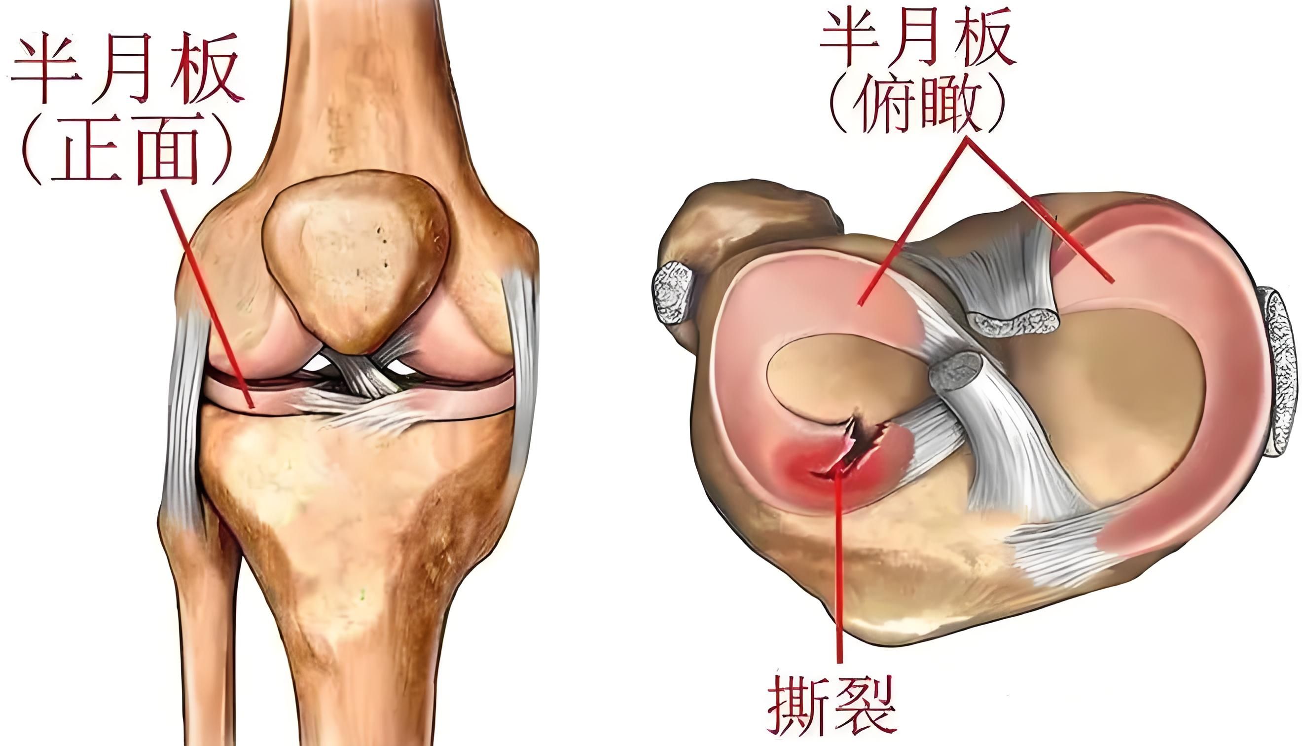 半月板位置示意图图片