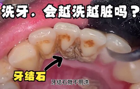 牙齿洗牙后,会更容易脏吗?看完后感觉真的要去洗牙了哔哩哔哩bilibili