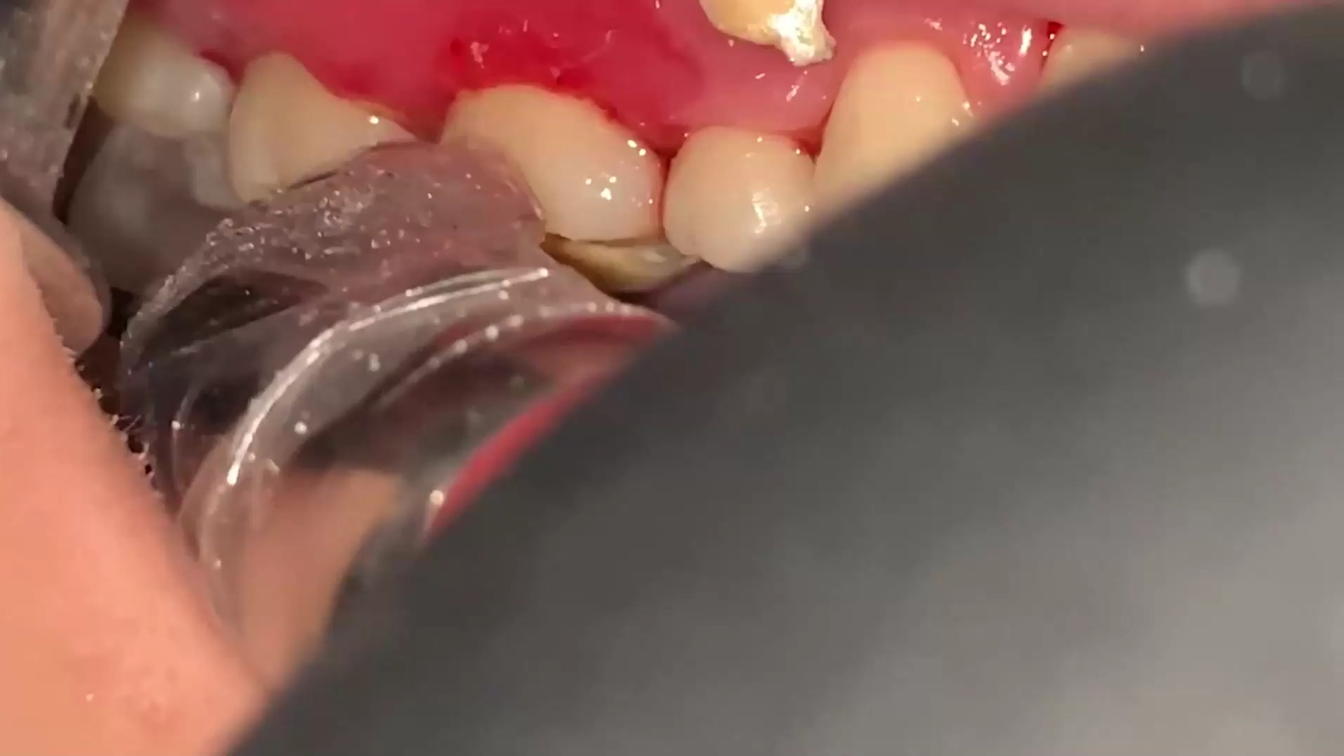 牙结石用什么好, 牙齿内侧的牙结石有什么方法可以去除?