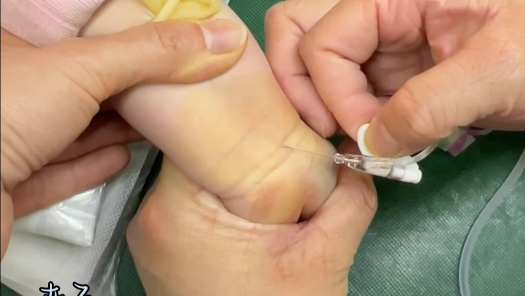 小儿静脉留置针日常分享