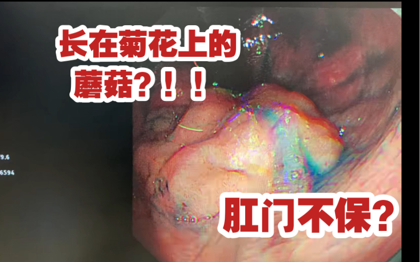 痔疮上面长息肉,大哥差点菊花不保!!哔哩哔哩bilibili