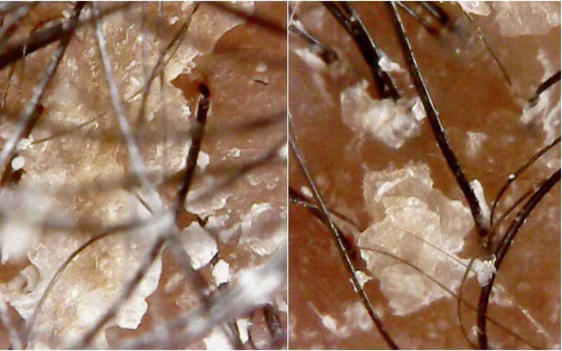 头皮屑显微镜放大图图片