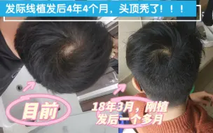 Télécharger la video: 成都发际线植发4年4个月后，头顶恶化了，老哥们，植发后一定要注意保养呀，又感染了幽门螺杆菌，我裂开了