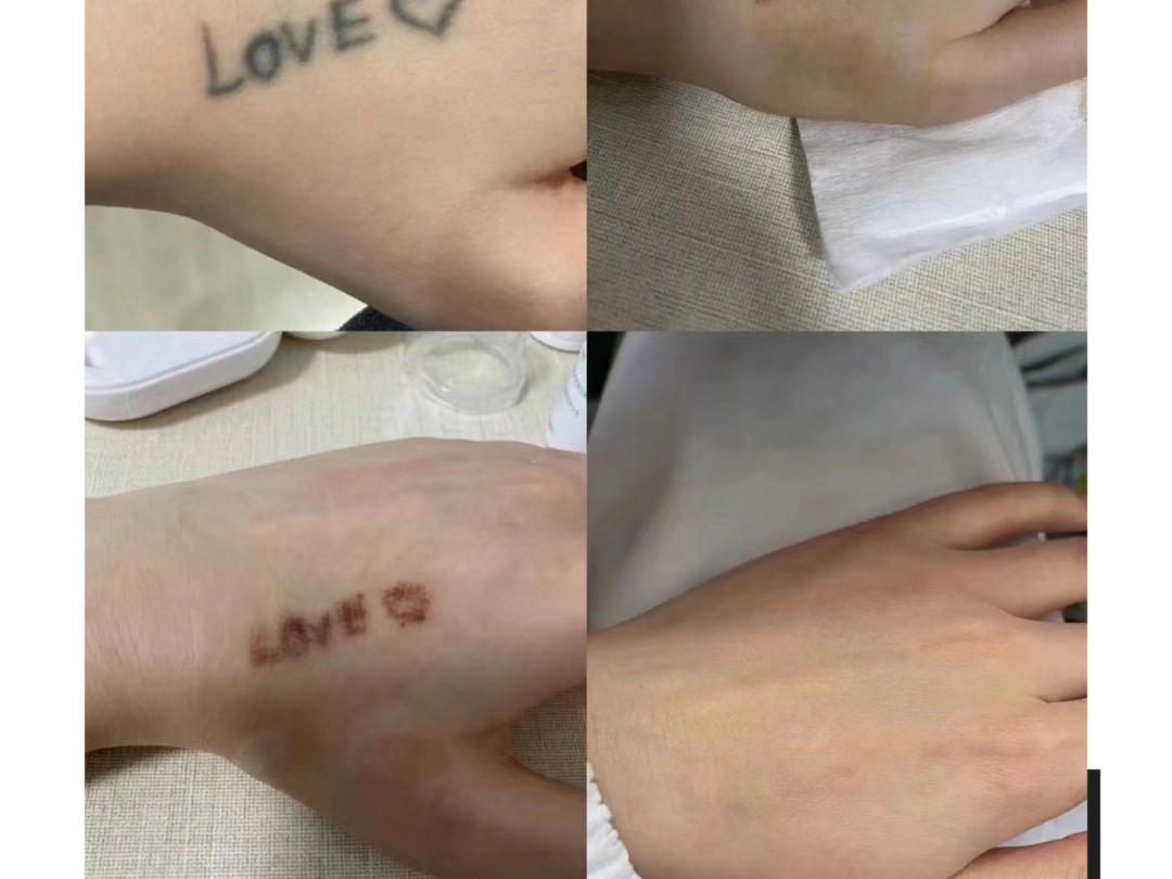 近期清洗效果 专业清洗纹身