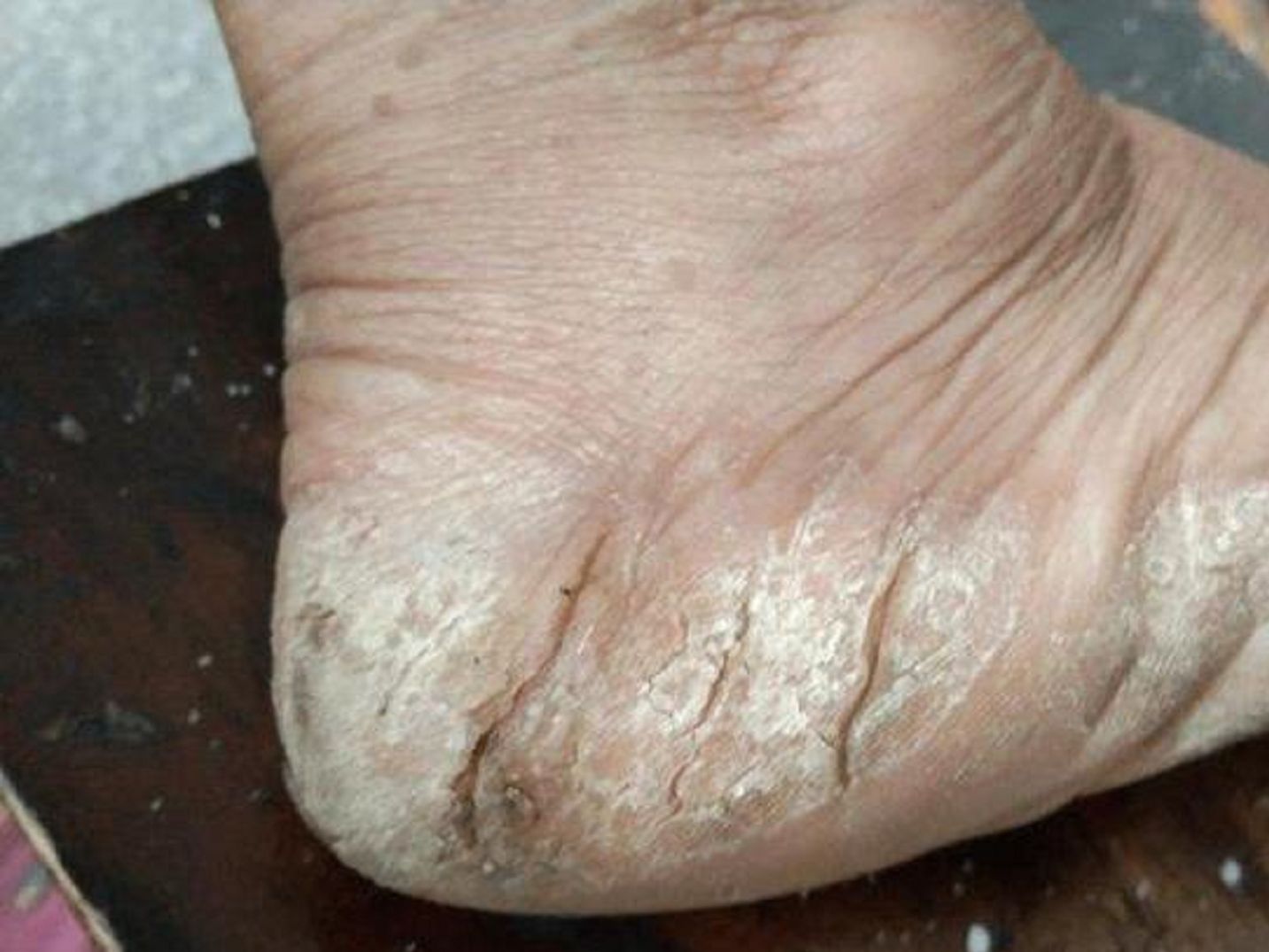 脚后跟皲裂很粗糙怎么办?有没有什么方法可以改善?