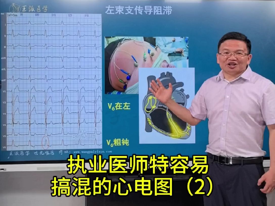 1分钟学会1个心电图一句话搞定左束支传导阻滞哔哩哔哩bilibili